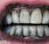 Zobu tīrīšana ar aktīvo ogli ir kaitīga