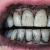 Чистить зубы активированным углем вредно